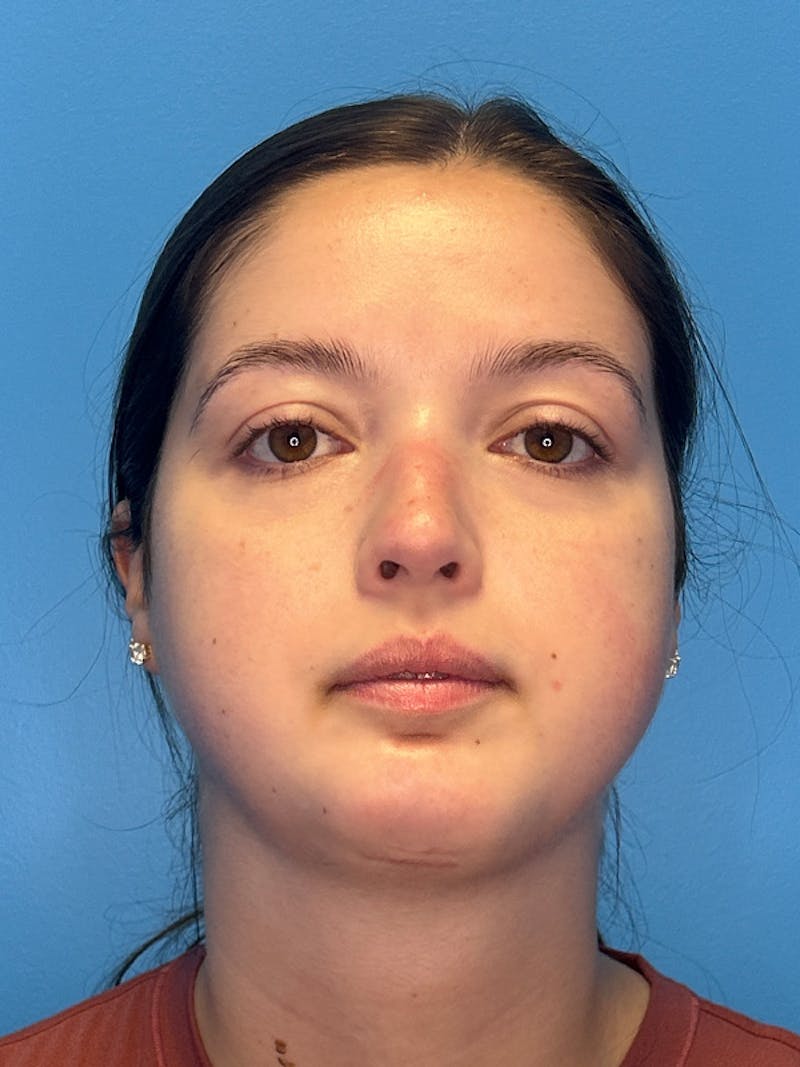 SWIFT LIFT ® / Facelift / Necklift  Before & After Gallery - Patient 144336 - Image 2
