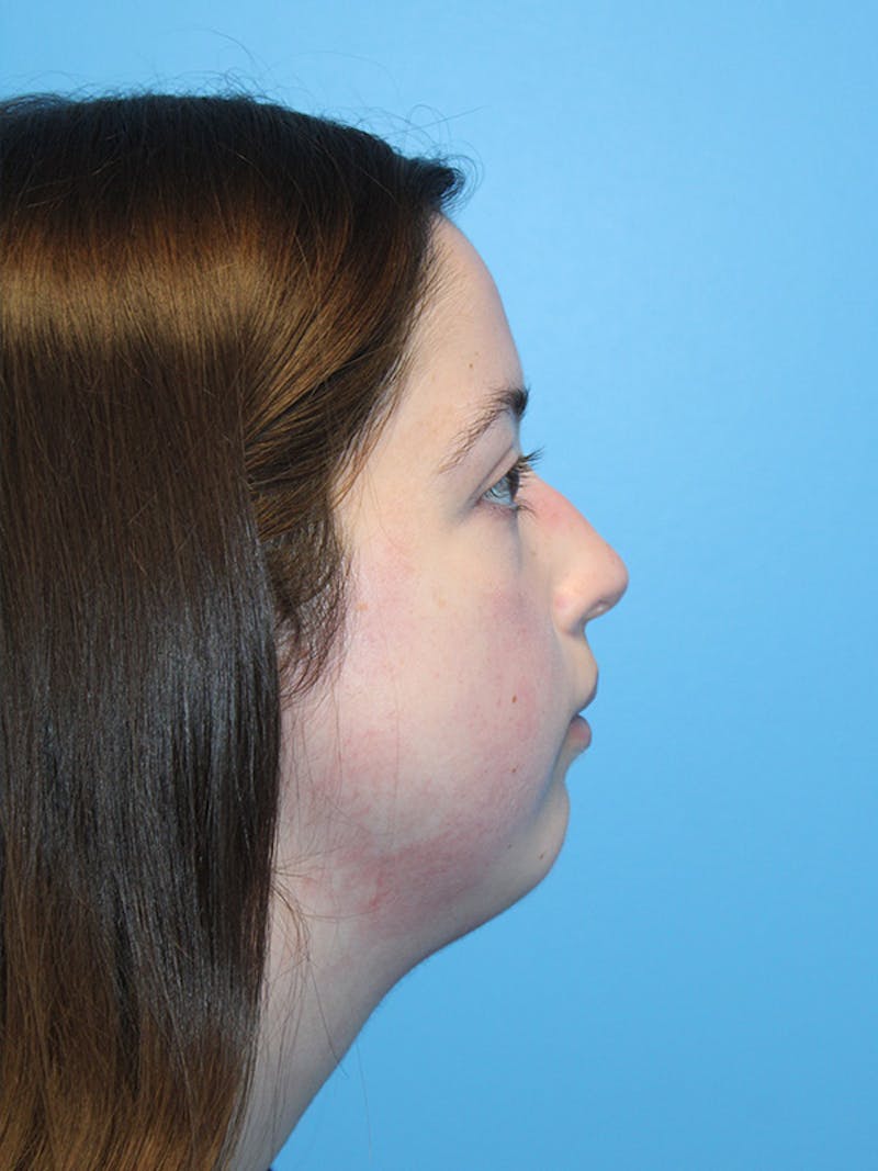 SWIFT LIFT ® / Facelift / Necklift  Before & After Gallery - Patient 144336 - Image 3
