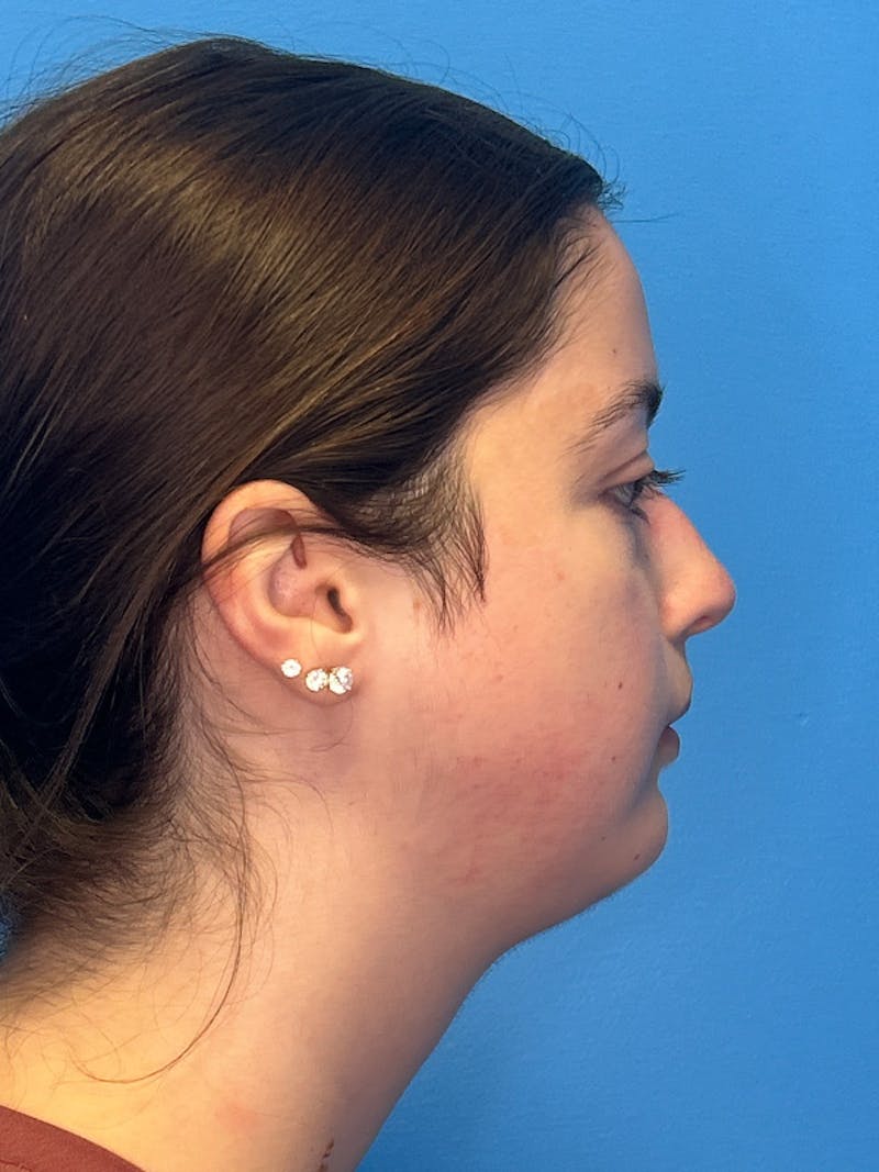 SWIFT LIFT ® / Facelift / Necklift  Before & After Gallery - Patient 144336 - Image 4