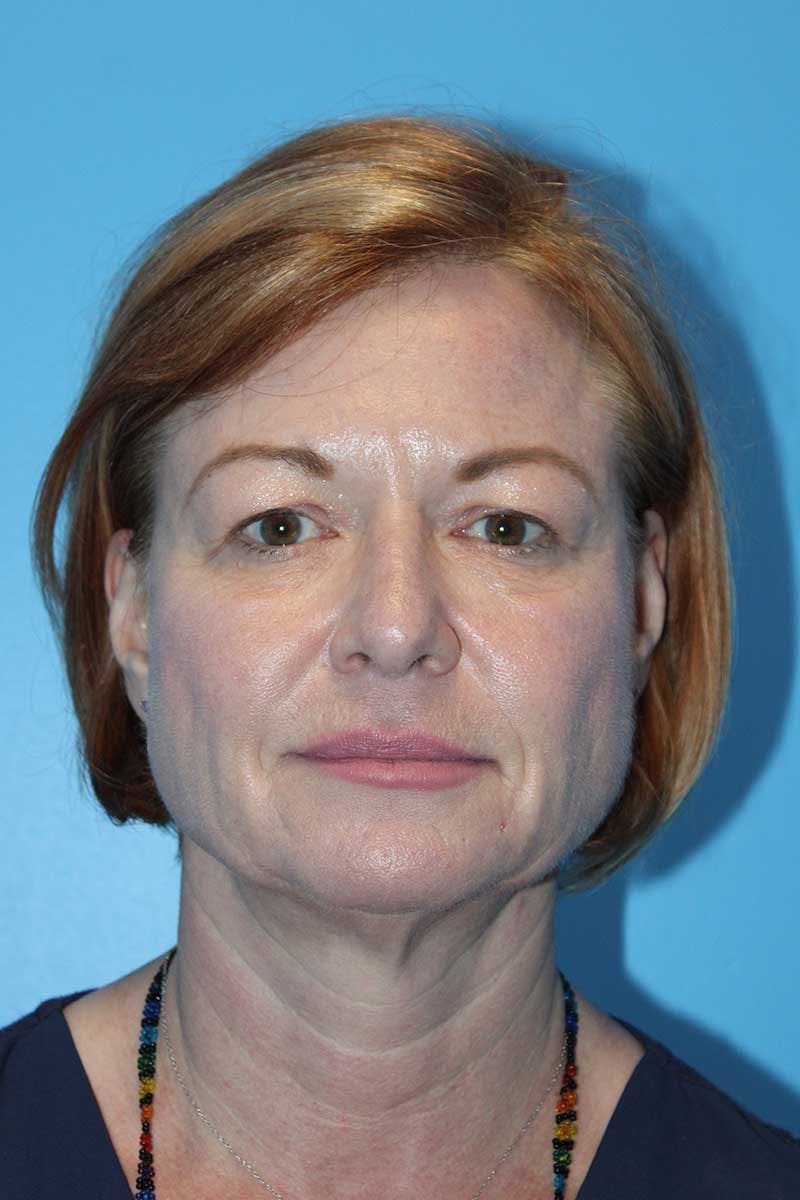 SWIFT LIFT ® / Facelift / Necklift  Before & After Gallery - Patient 116204 - Image 1