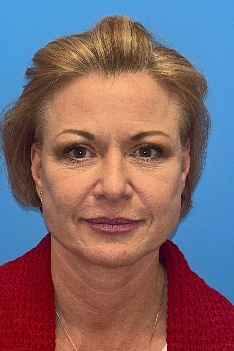 SWIFT LIFT ® / Facelift / Necklift  Before & After Gallery - Patient 116204 - Image 2