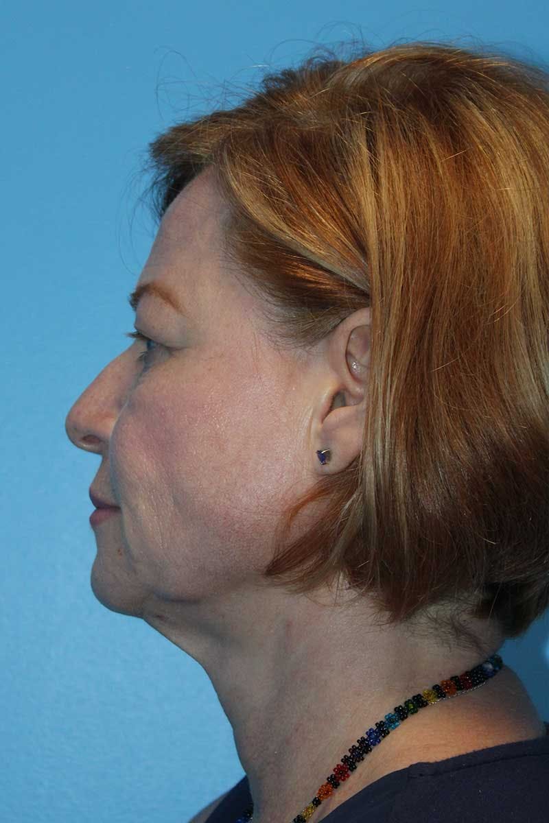 SWIFT LIFT ® / Facelift / Necklift  Before & After Gallery - Patient 116204 - Image 3