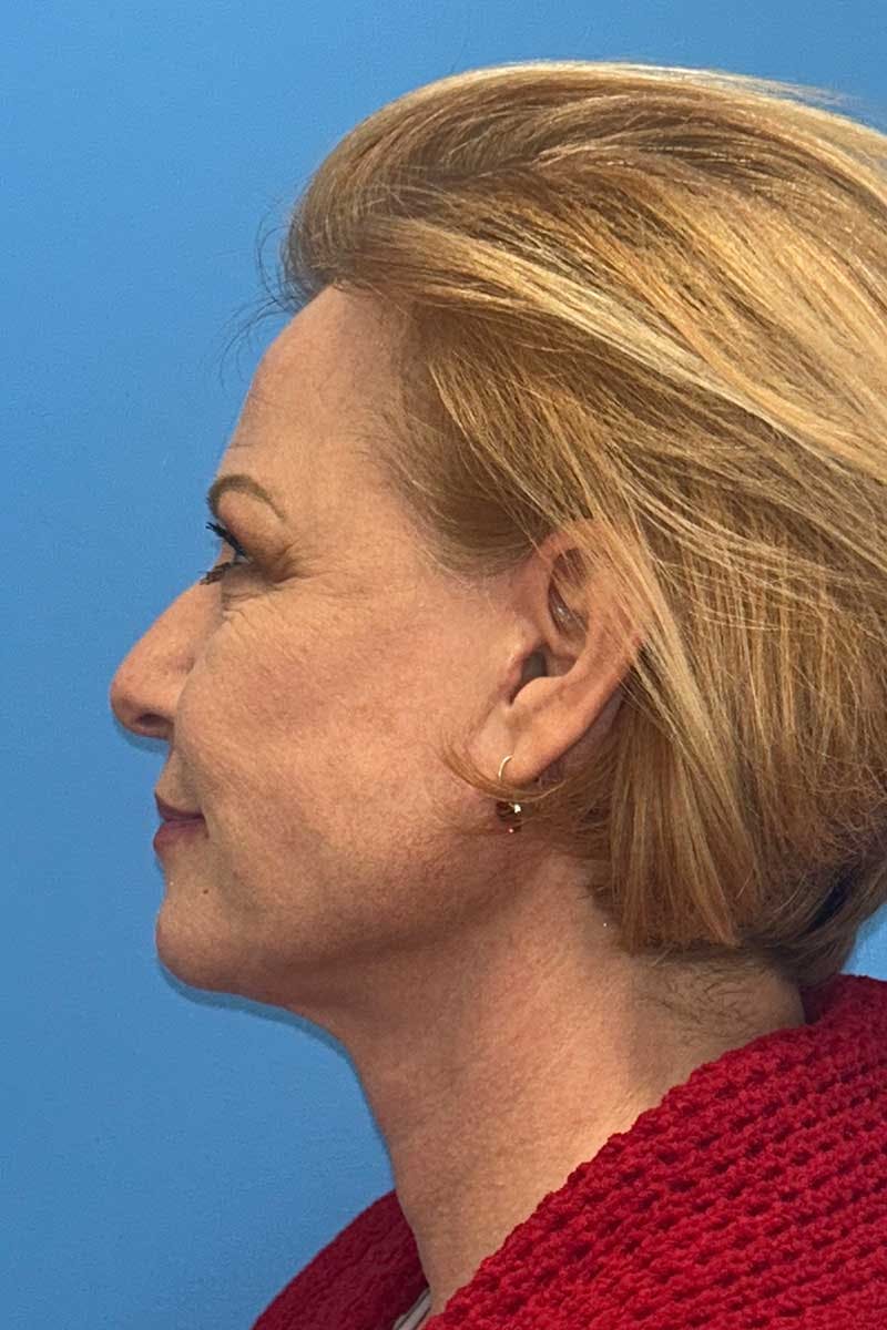 SWIFT LIFT ® / Facelift / Necklift  Before & After Gallery - Patient 116204 - Image 4