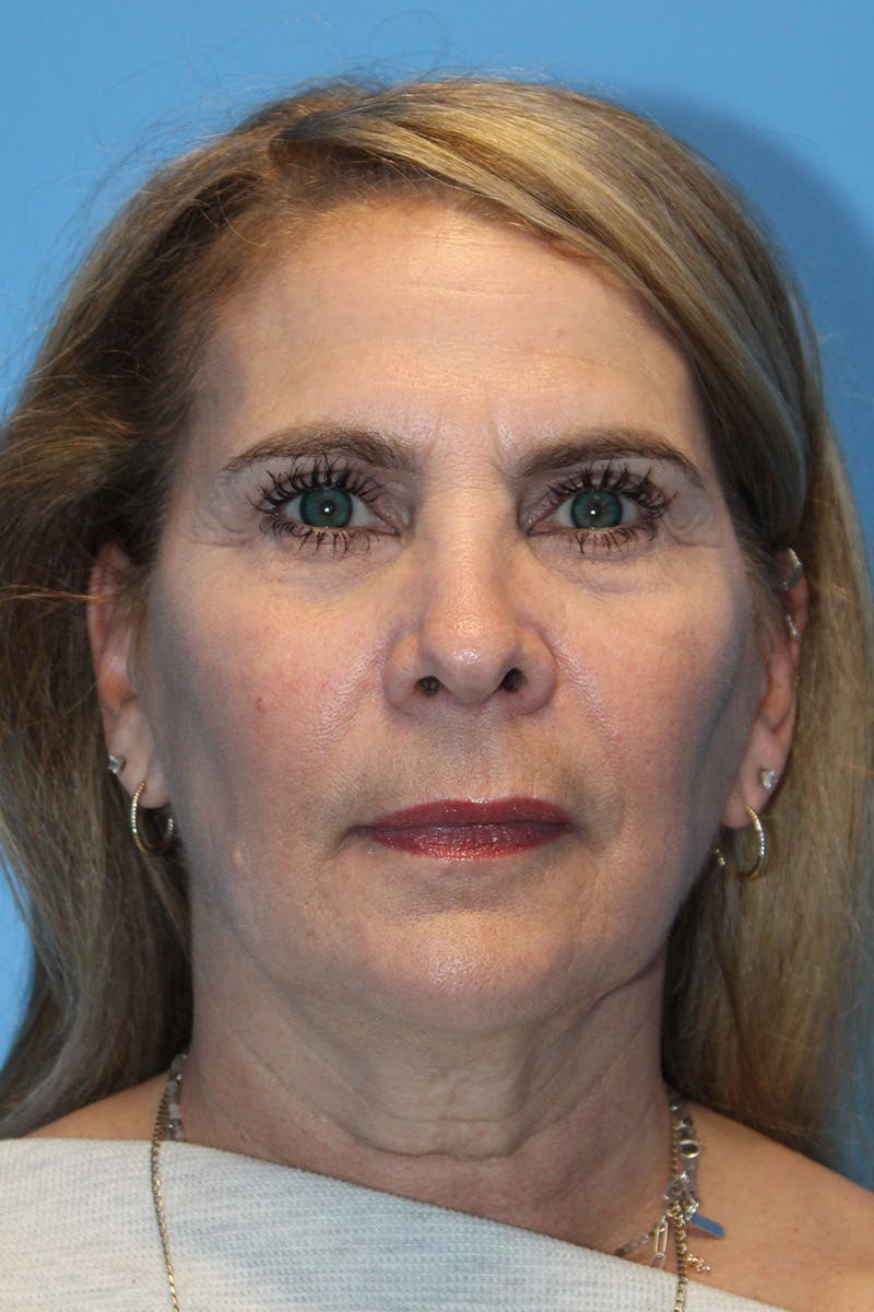 SWIFT LIFT ® / Facelift / Necklift  Before & After Gallery - Patient 245734 - Image 1