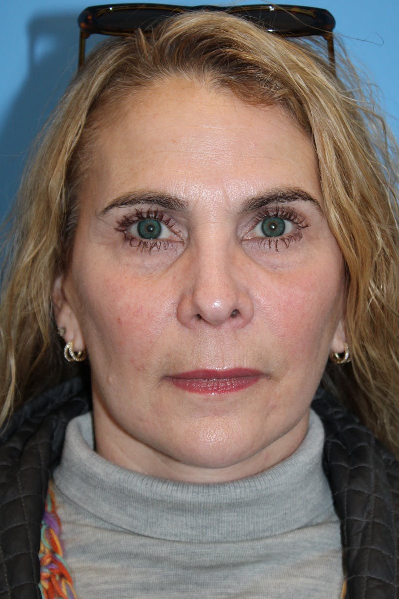 SWIFT LIFT ® / Facelift / Necklift  Before & After Gallery - Patient 245734 - Image 2