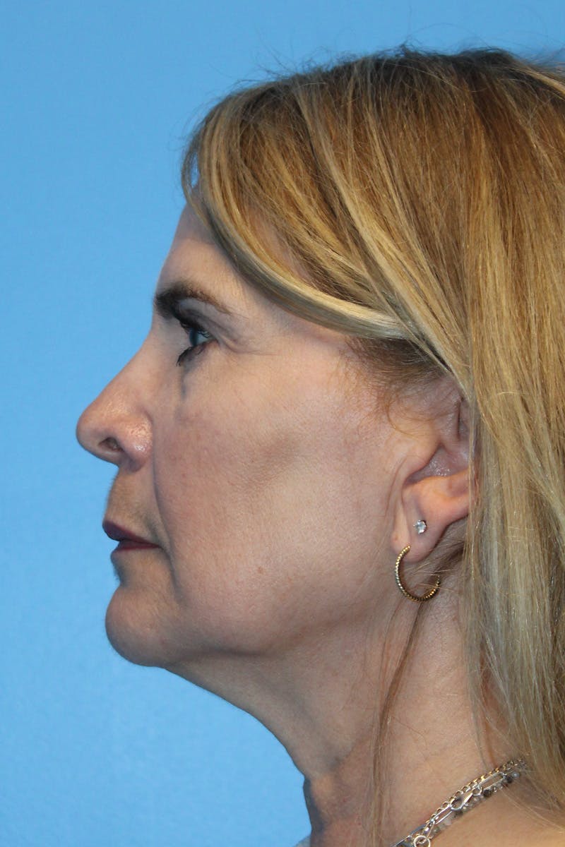 SWIFT LIFT ® / Facelift / Necklift  Before & After Gallery - Patient 245734 - Image 3