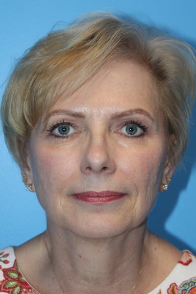 SWIFT LIFT ® / Facelift / Necklift  Before & After Gallery - Patient 312926 - Image 1