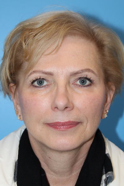 SWIFT LIFT ® / Facelift / Necklift  Before & After Gallery - Patient 312926 - Image 2