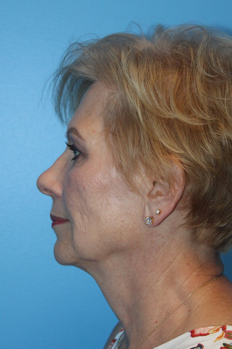 SWIFT LIFT ® / Facelift / Necklift  Before & After Gallery - Patient 312926 - Image 3