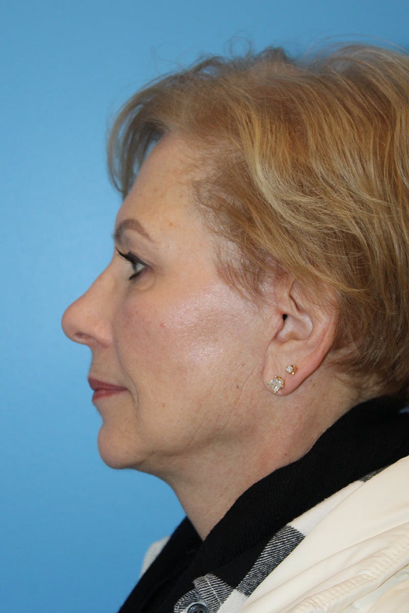 SWIFT LIFT ® / Facelift / Necklift  Before & After Gallery - Patient 312926 - Image 4