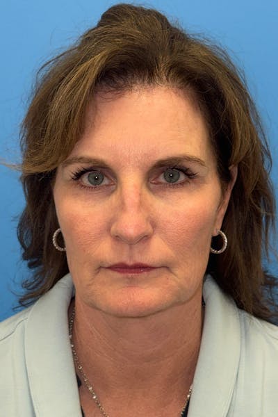 SWIFT LIFT ® / Facelift / Necklift  Before & After Gallery - Patient 426863 - Image 1