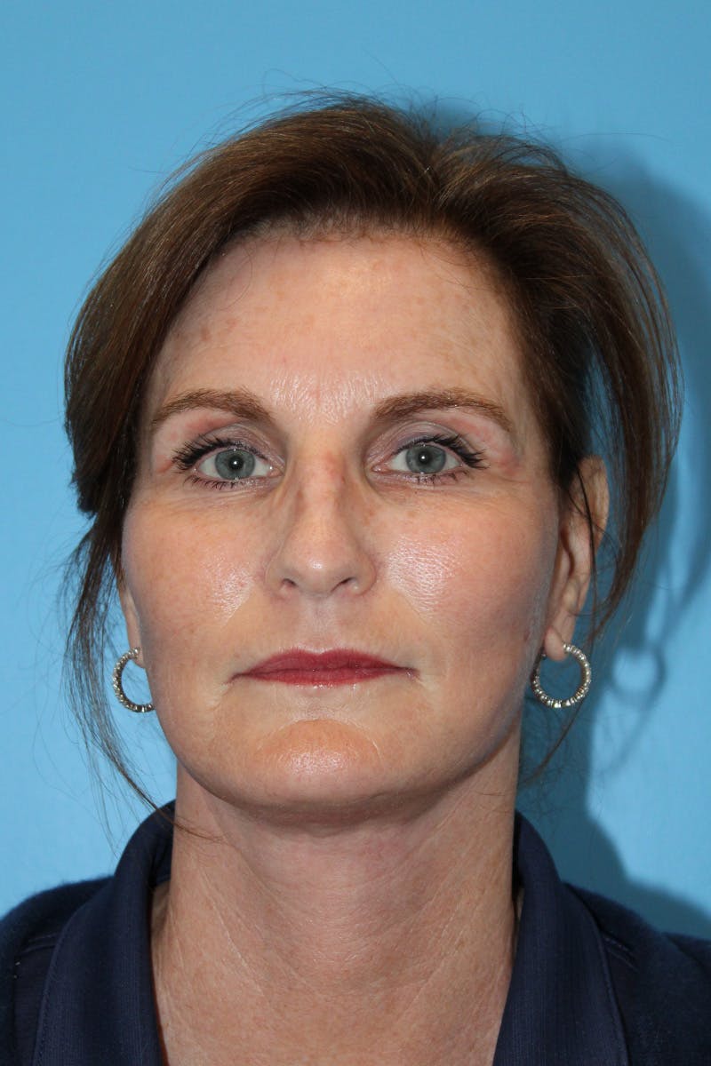 SWIFT LIFT ® / Facelift / Necklift  Before & After Gallery - Patient 426863 - Image 2