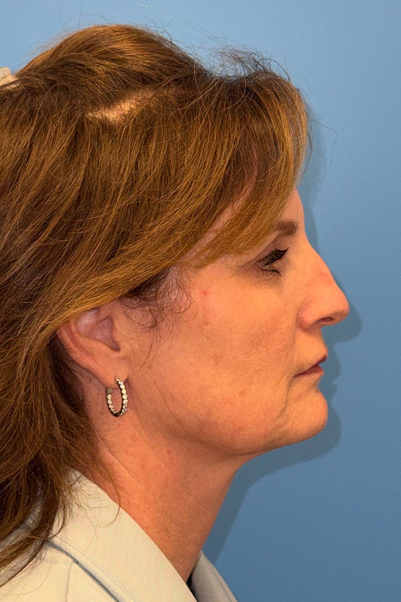 SWIFT LIFT ® / Facelift / Necklift  Before & After Gallery - Patient 426863 - Image 3