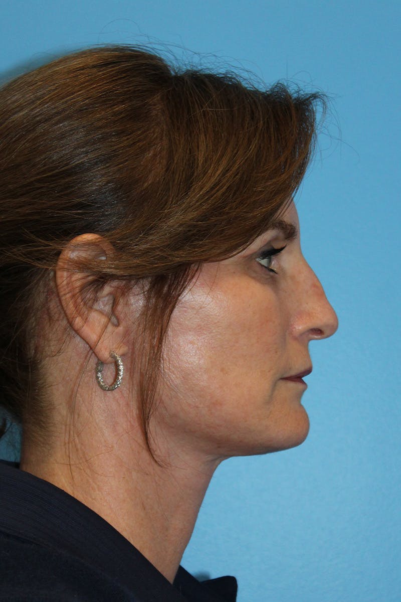 SWIFT LIFT ® / Facelift / Necklift  Before & After Gallery - Patient 426863 - Image 4