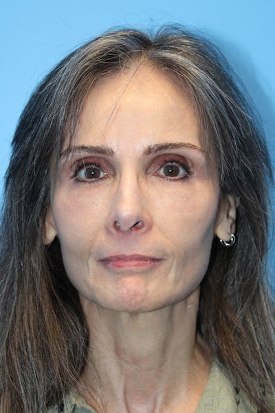 Revision Rhinoplasty Before & After Gallery - Patient 305940 - Image 1