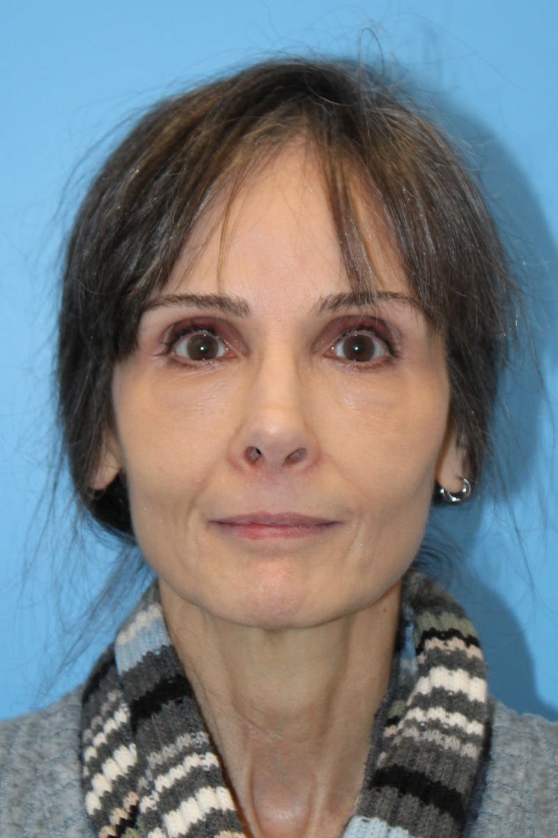 Revision Rhinoplasty Before & After Gallery - Patient 305940 - Image 2