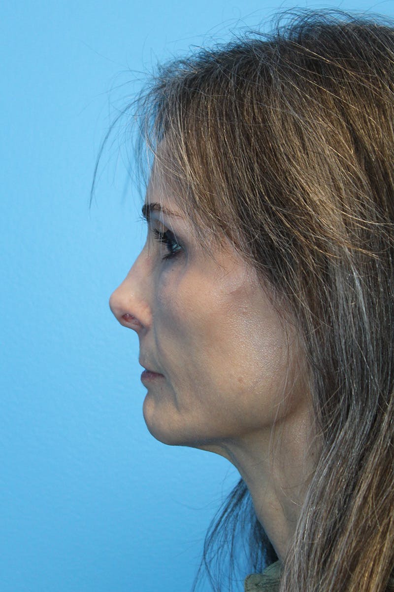 Revision Rhinoplasty Before & After Gallery - Patient 305940 - Image 3