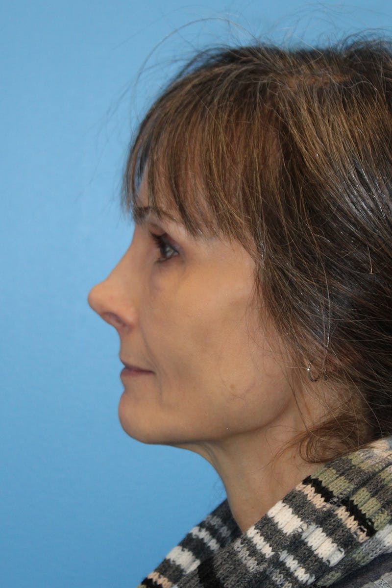 Revision Rhinoplasty Before & After Gallery - Patient 305940 - Image 4