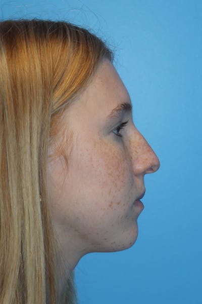 Rhinoplasty Before & After Gallery - Patient 424809 - Image 1