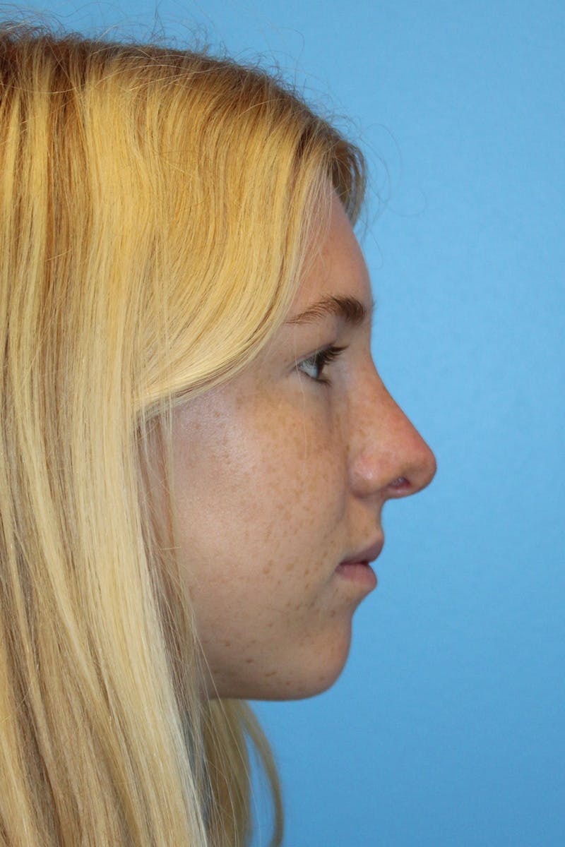 Rhinoplasty Before & After Gallery - Patient 424809 - Image 2