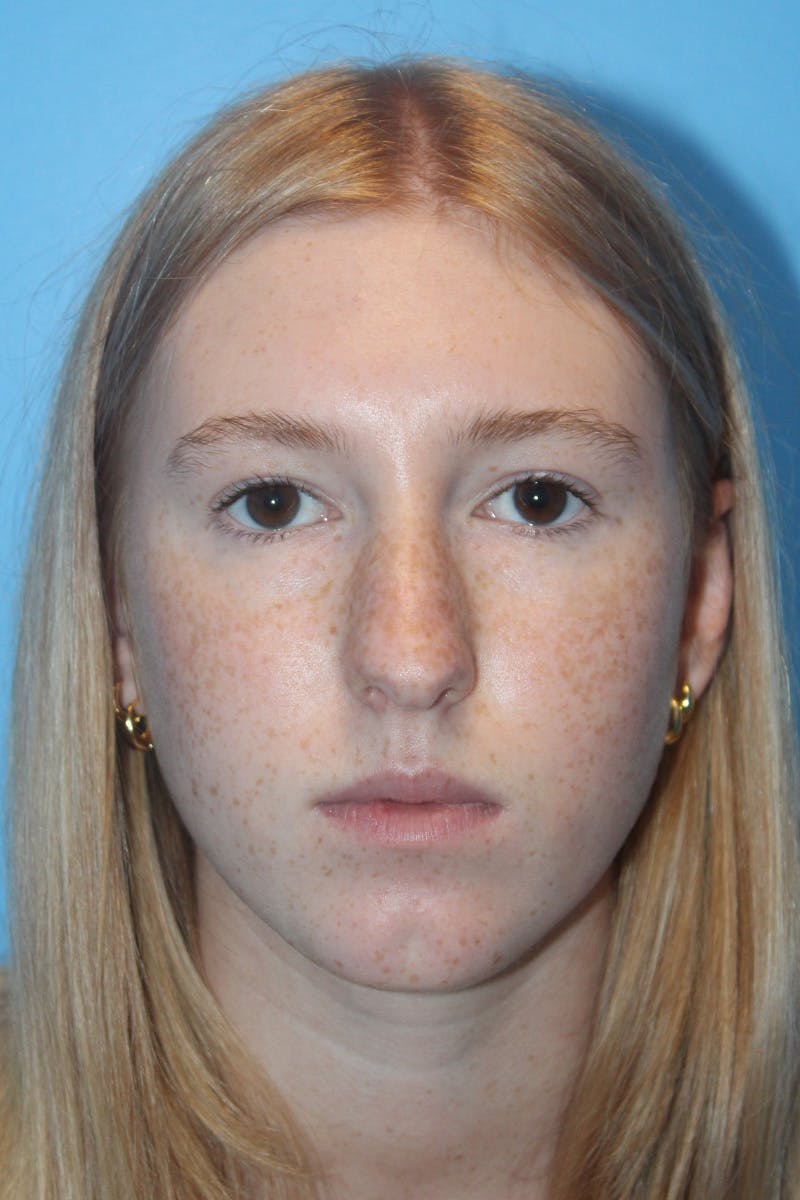 Rhinoplasty Before & After Gallery - Patient 424809 - Image 3