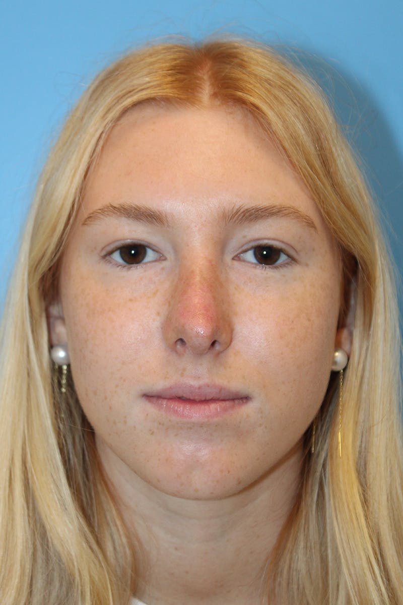 Rhinoplasty Before & After Gallery - Patient 424809 - Image 4