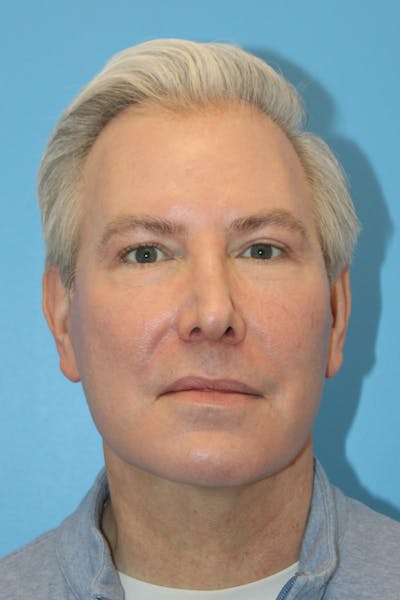 SWIFT LIFT ® / Facelift / Necklift  Before & After Gallery - Patient 368642 - Image 2