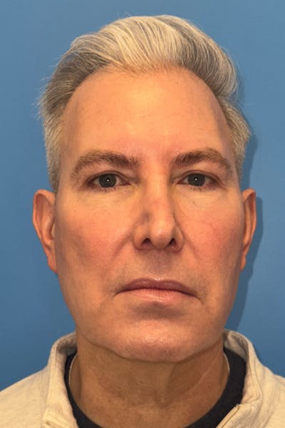 SWIFT LIFT ® / Facelift / Necklift  Before & After Gallery - Patient 368642 - Image 1