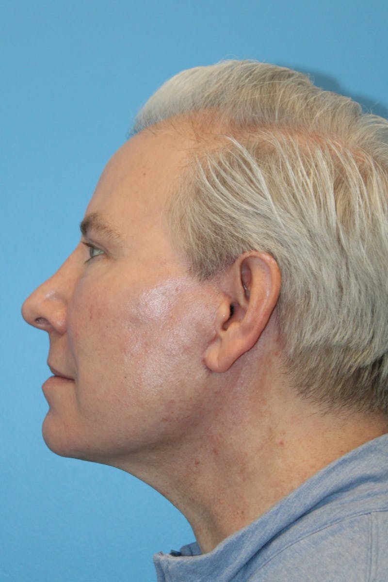 SWIFT LIFT ® / Facelift / Necklift  Before & After Gallery - Patient 368642 - Image 4
