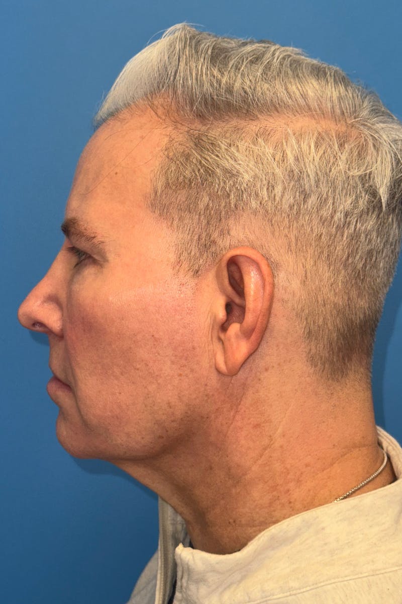 SWIFT LIFT ® / Facelift / Necklift  Before & After Gallery - Patient 368642 - Image 3