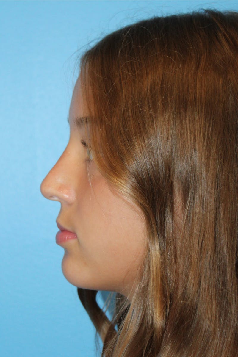 Rhinoplasty Before & After Gallery - Patient 234838 - Image 2