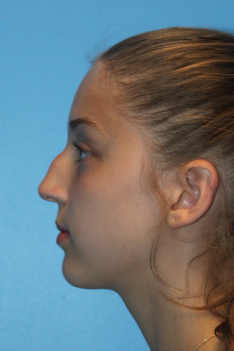 Rhinoplasty Before & After Gallery - Patient 234838 - Image 1