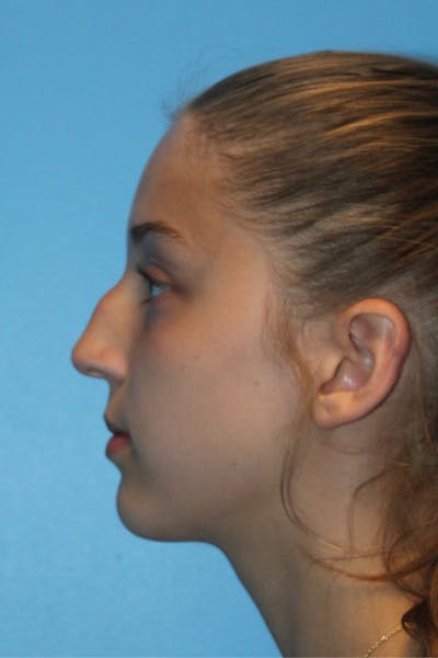 Rhinoplasty Before & After Gallery - Patient 234838 - Image 1
