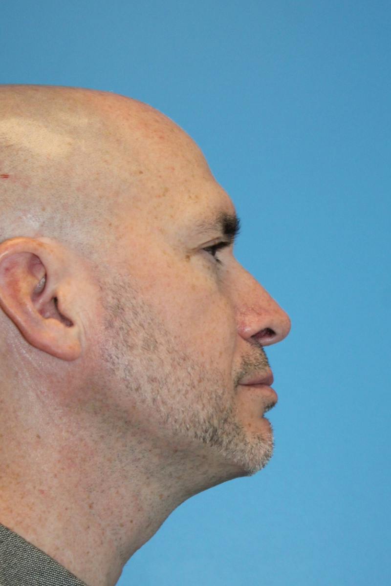 Rhinoplasty Before & After Gallery - Patient 356238 - Image 2