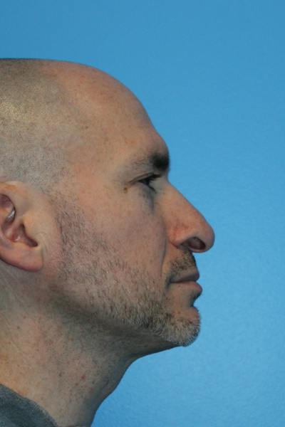 Rhinoplasty Before & After Gallery - Patient 356238 - Image 1