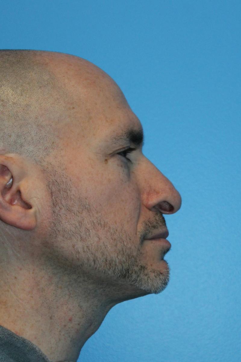 Rhinoplasty Before & After Gallery - Patient 356238 - Image 1