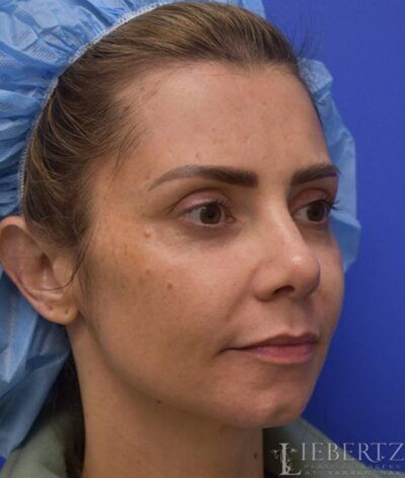 Chin Augmentation Before & After Gallery - Patient 342112 - Image 3