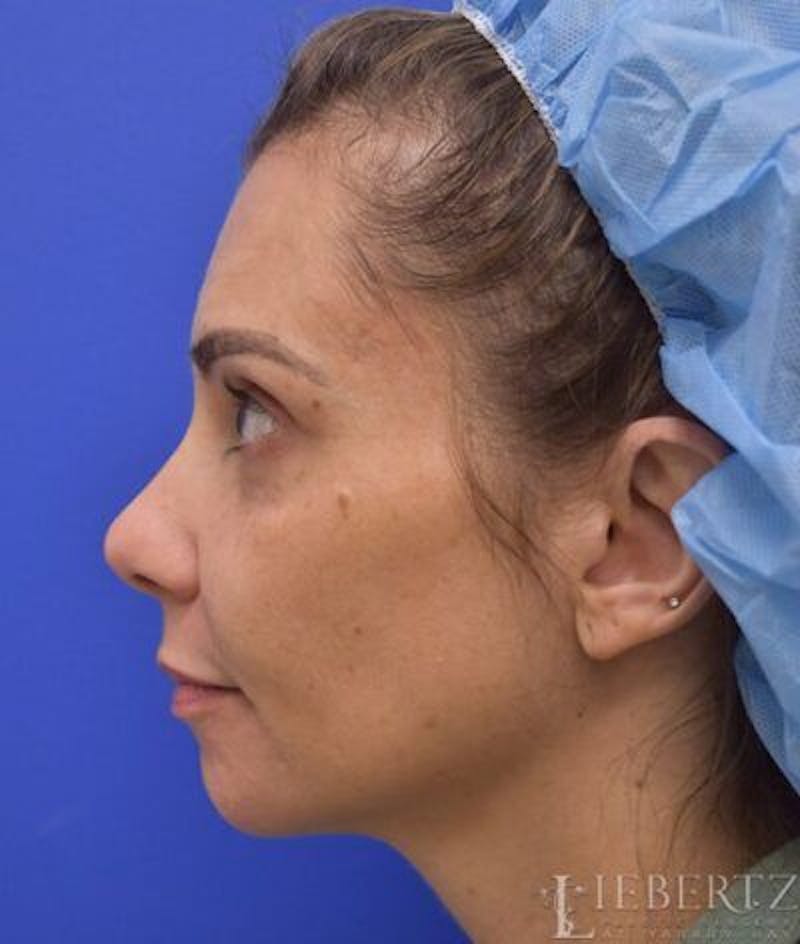 Chin Augmentation Before & After Gallery - Patient 342112 - Image 5