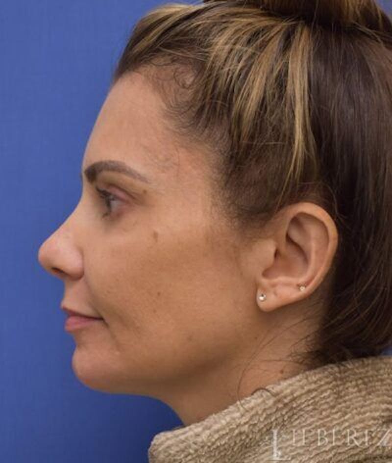 Chin Augmentation Before & After Gallery - Patient 342112 - Image 6