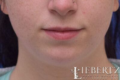 Chin Augmentation Before & After Gallery - Patient 290086 - Image 1