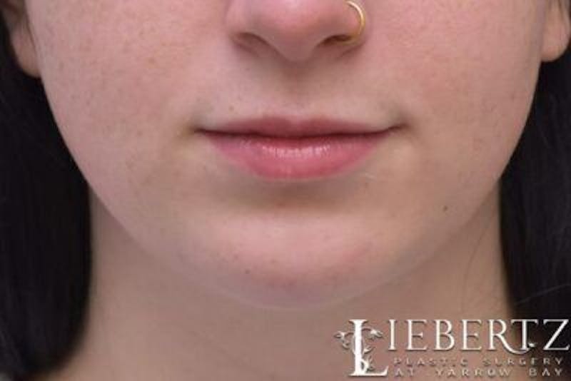 Chin Augmentation Before & After Gallery - Patient 290086 - Image 2