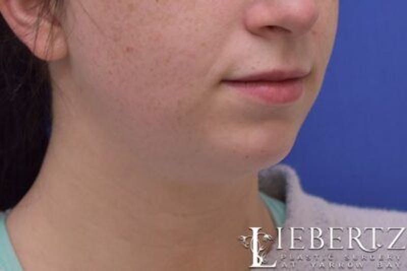 Chin Augmentation Before & After Gallery - Patient 290086 - Image 3