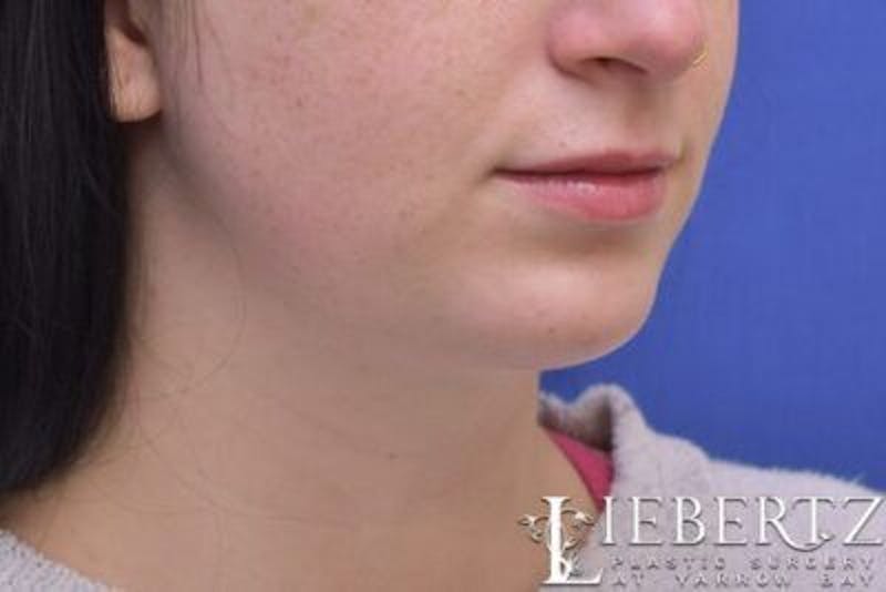 Chin Augmentation Before & After Gallery - Patient 290086 - Image 4