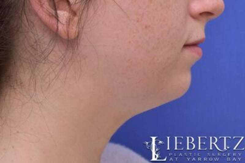 Chin Augmentation Before & After Gallery - Patient 290086 - Image 5