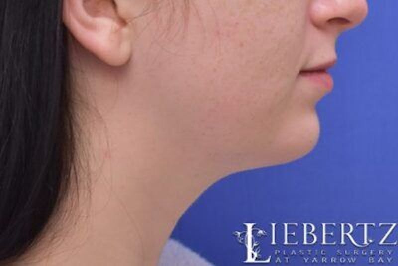 Chin Augmentation Before & After Gallery - Patient 290086 - Image 6
