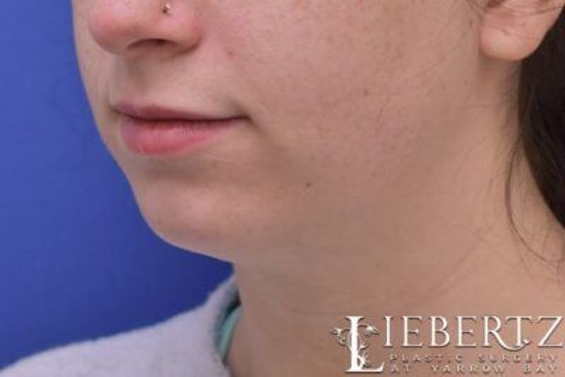 Chin Augmentation Before & After Gallery - Patient 290086 - Image 7