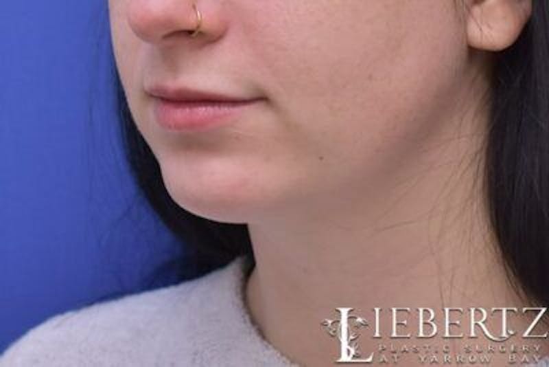 Chin Augmentation Before & After Gallery - Patient 290086 - Image 8