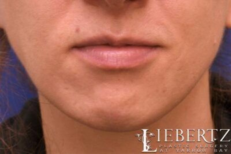 Chin Augmentation Before & After Gallery - Patient 163940 - Image 1
