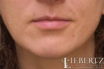 Chin Augmentation Before & After Gallery - Patient 163940 - Image 2