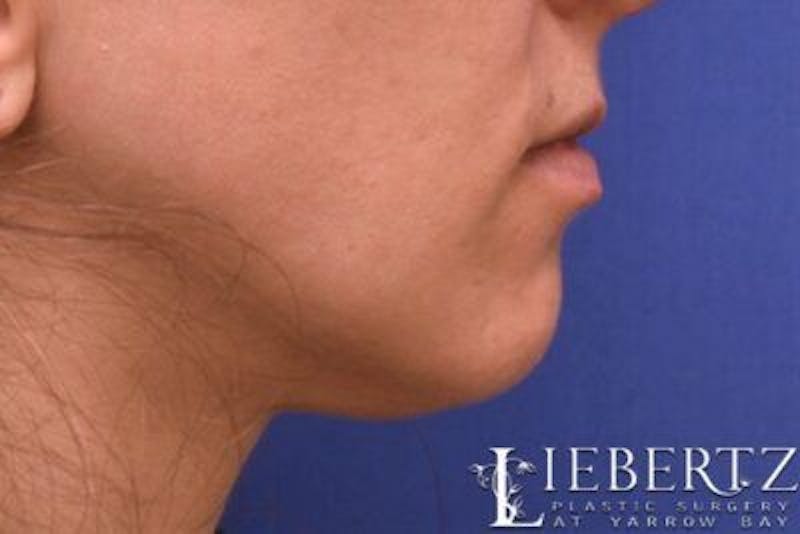 Chin Augmentation Before & After Gallery - Patient 163940 - Image 3